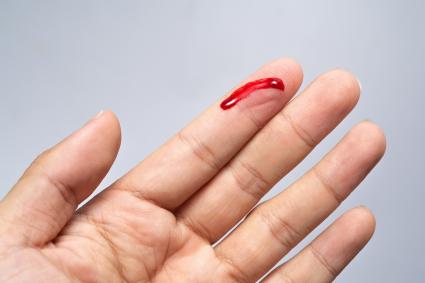 thumbnail of People Suffering From Hemophilia Are Susceptible to Bleeding Excessively